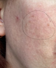 Skin blemishes