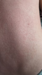 Rash on toddler