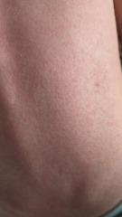 Rash on toddler