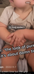 Rett syndrome hand wringing, 12 mo old