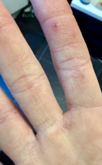Right hand is constantly dry, cracked and painful while my left is fine