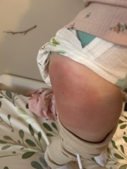 Bad reaction to vaccine