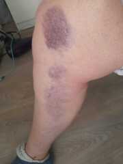 Feel lucky to be alive after falling forward down my stairs.
