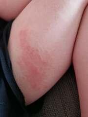 Eczema advice