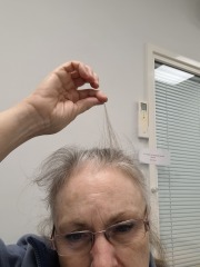 Hair regrowth.