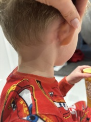 Lump behind ear- chicken pox?