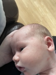 Any idea about this rash?