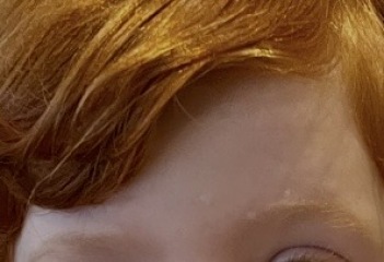 Chicken pox pock marks- the after scars! 