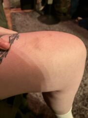 Random bruising and leg paid