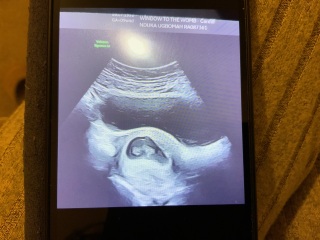 Ramzi guess abdomial