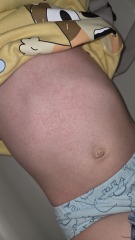 Rash on toddler