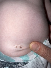 Umbilical cord