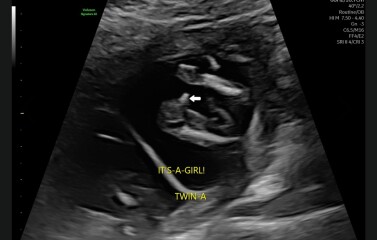 Anyone think early scan at 15 weeks for twins could be wrong??
