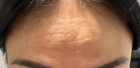 Botox pros and cons?