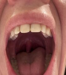 Agonising throat - pics