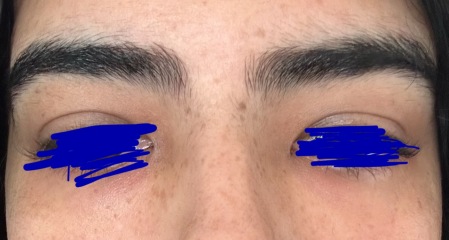 Please help me fade these freckles (pics)