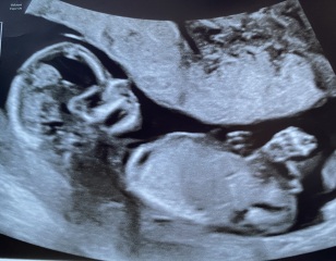 13 weeks scan - boy or girl?