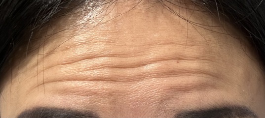 Botox pros and cons?