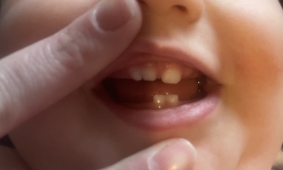 Does anyone have a child with teeth fused together?