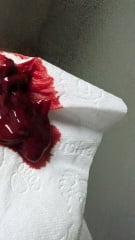 Would you wait? TW blood clots