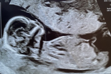 13 weeks scan - boy or girl?