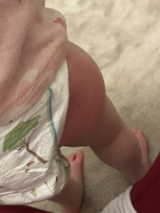 Swollen legs after vaccination