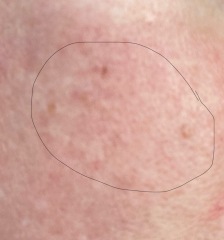 Skin blemishes