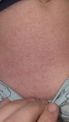 Rash on toddler