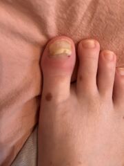 Why does my toenail keep falling off? (Photos)