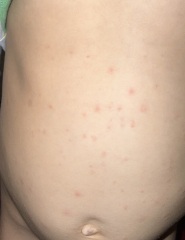 Mysterious red spots on toddler
