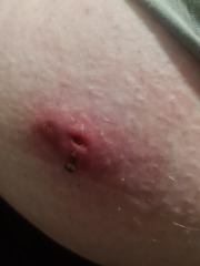 Skin Abscess Photos Attached.
