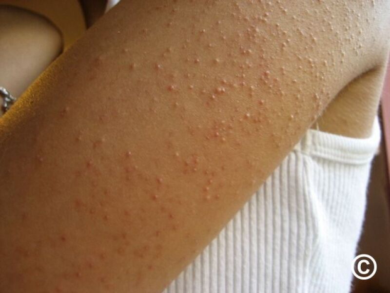 Anyone have experience of keratosis pilaris on the face?