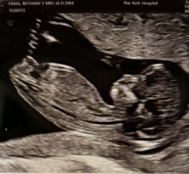 Guess the gender please - 12 week scan 