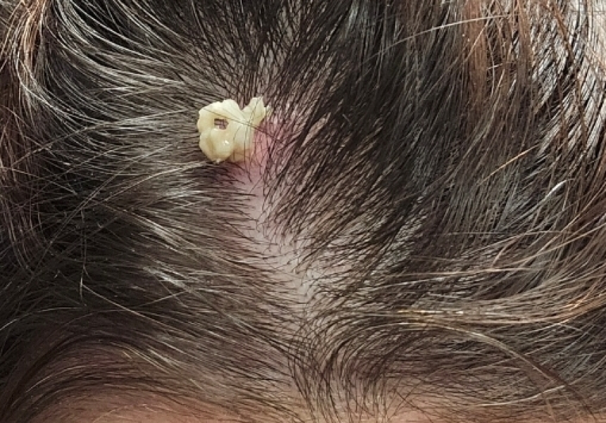 Delightful scalp cyst contents (warning: puss)