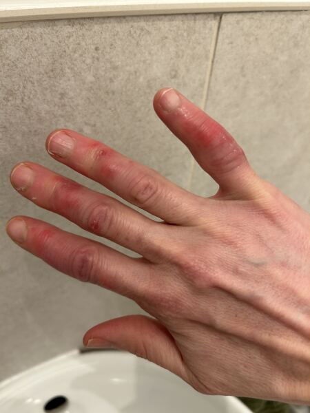 Constantly cold cracked hands