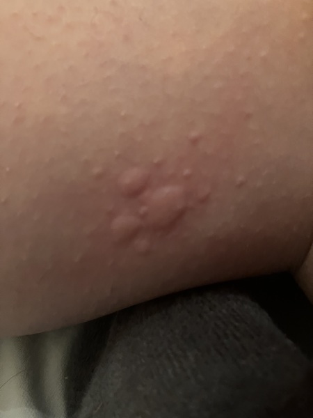 Please help, is this shingles?