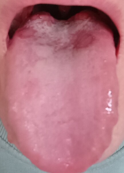 Does anyone have any idea why my tongue often looks like this?