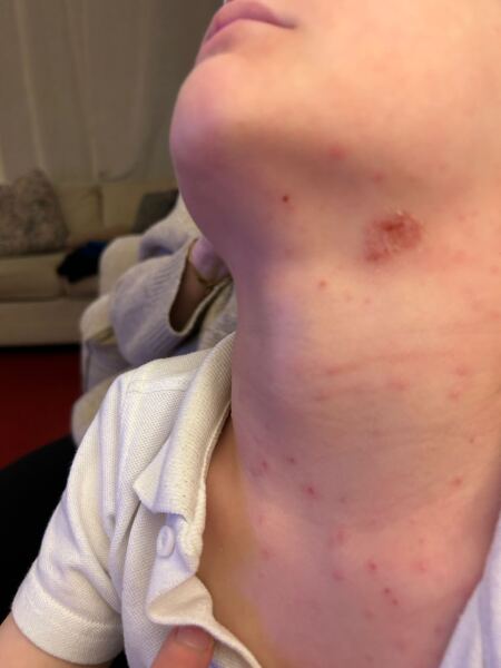 Photos - 5 year old rash that won’t heal