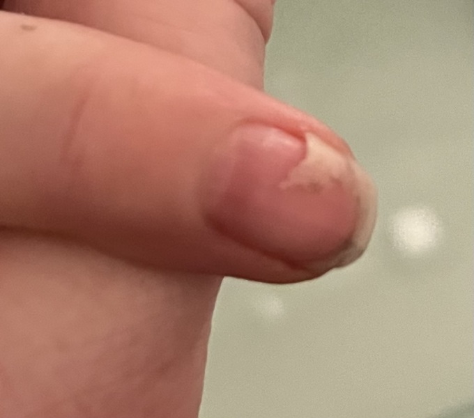 Split nail (photo) - advice please