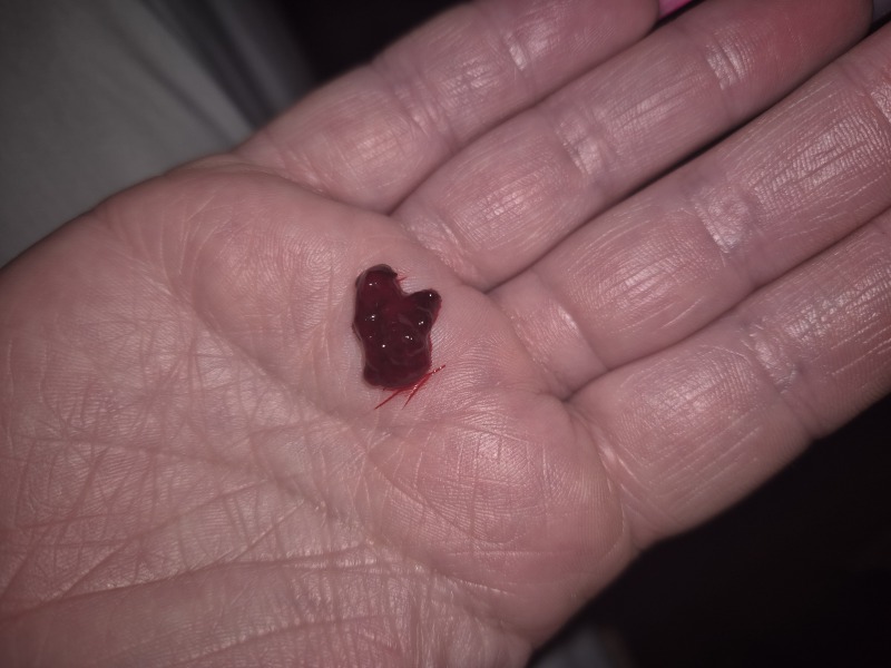 Deep cleaning on teeth