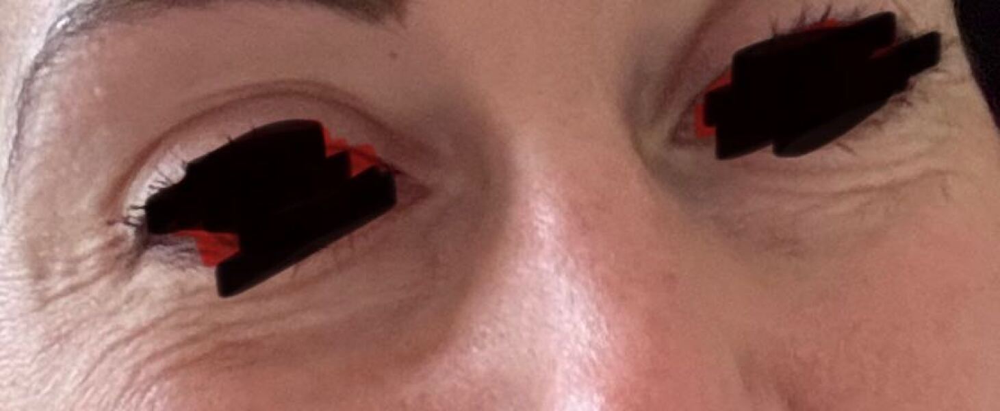 Eye wrinkles / bags / crows feet