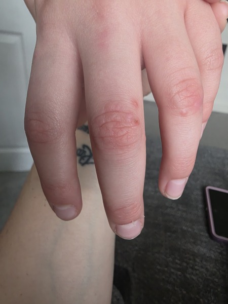 Spots on joints of fingers?