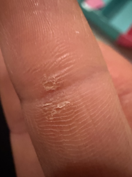 Is this a wart or dry skin??