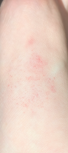 Weird rash on foot