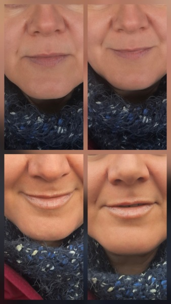 Lip fillers- are the agony?