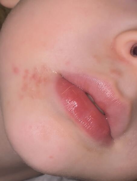 Spots on sons face? No idea and doctor doesn’t know?