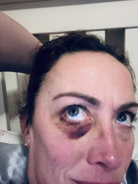 What would you think if you saw someone with a black eye