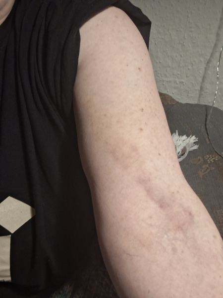 What might this bruise be?