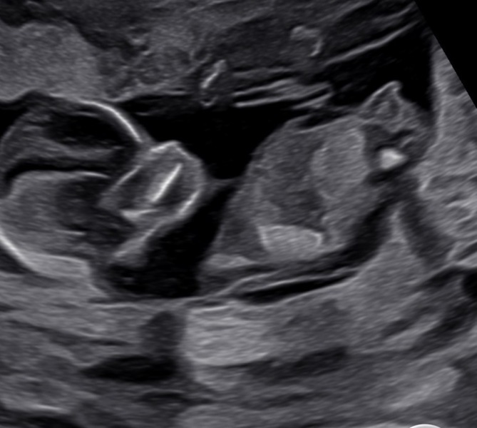 Boy or girl
