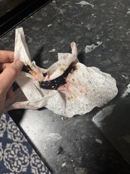 Is this miscarriage or just late period due to stress?